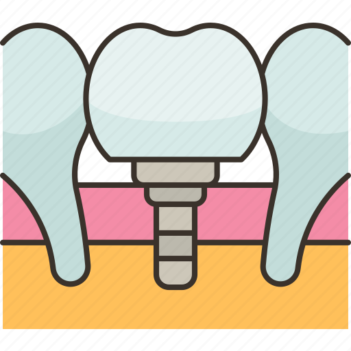 Dental, implant, tooth, dentistry, surgery icon - Download on Iconfinder