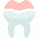 dental, onlays, restoration, oral, health