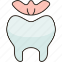 dental, inlays, restoration, oral, health