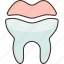 dental, onlays, restoration, oral, health 