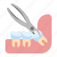 dental, extraction, tooth, wisdom 