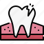dentistry, dental care, dentist, medical, tooth, broken, tooth crack, cavity, molar 