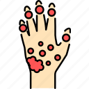 psoriatic, arthritis, hand