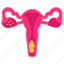 abnormal, uterine, bleeding, extremely, heavy period, leakage, uterus 